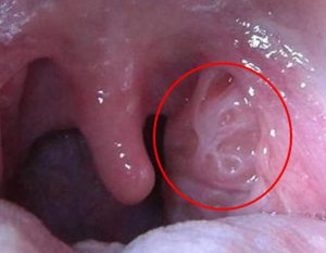 膿栓 臭い玉 が口臭原因 膿栓の取り方 ８つの根本対策法まとめ 口臭対策でキレイな息 口臭お悩み解決室